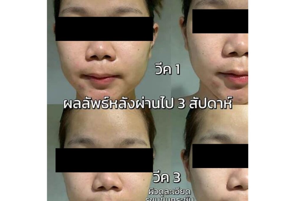 Retinol 1% VS Bakuchiol 2% – เปรียบเทียบผลลดริ้วรอยใน 6 สัปดาห์ พร้อม Before‑After